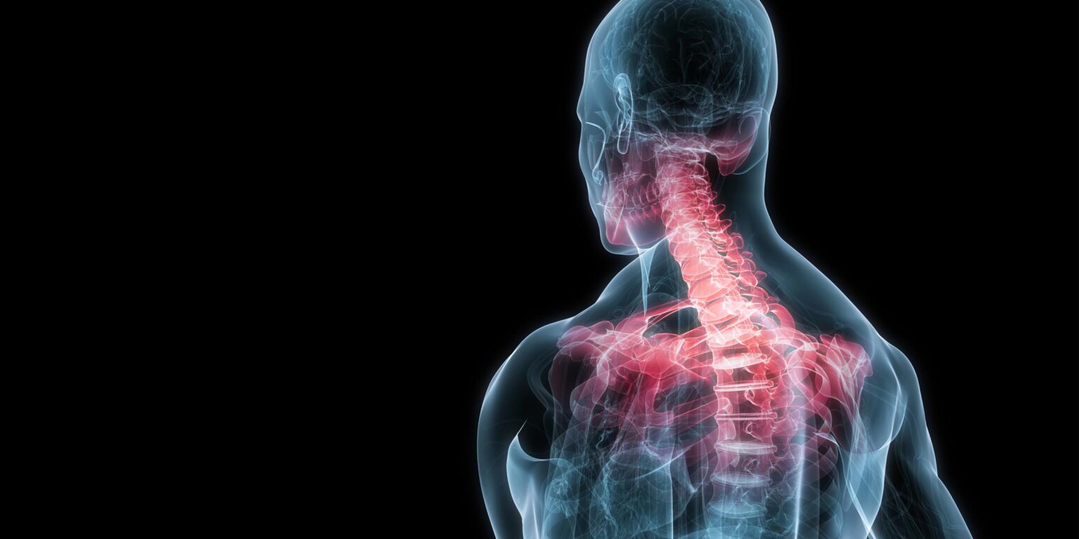 X-ray view of cervical spine highlighting nerve pain